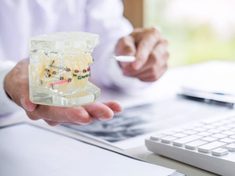 Model stomatologiczny szczęka zęby zębów aparat ortodontyczny