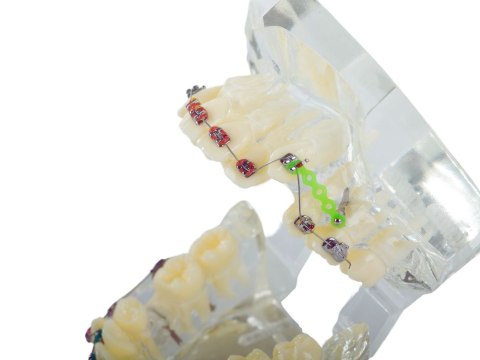 Model stomatologiczny szczęka zęby zębów aparat ortodontyczny